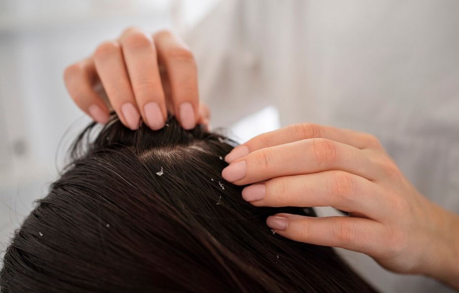 Kulit Kepala Gatal dan Bersisik? Masker Alpukat Bisa Jadi Solusi Alami