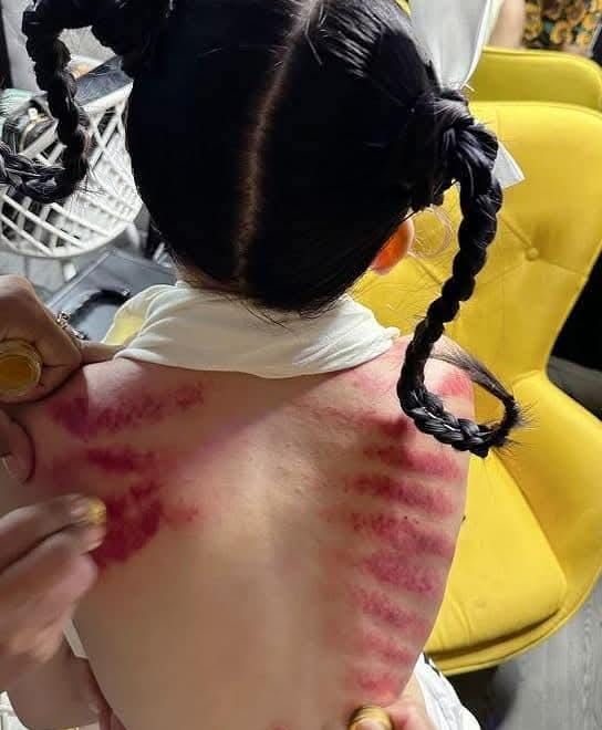 Masuk Angin Jangan Disepelekan, Pakar Kesehatan Ungkap Risiko Penyakit Serius