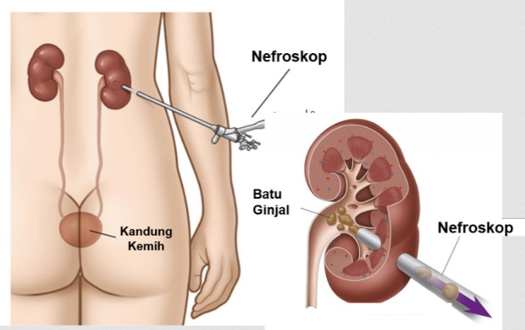 Jangan Sampai Operasi! Berikut Bahan Alami Ampuh Atasi Batu Ginjal, Mudah Ditemukan