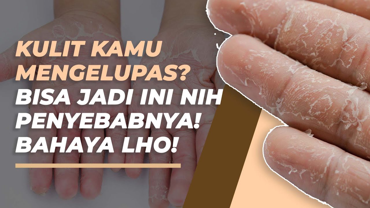 Kulit Tangan Mengelupas Parah? Begini Cara Mengatasinya, Sederhana dan Ampuh