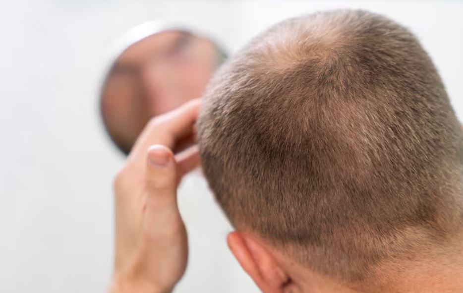 Stres Bisa Picu Rambut Rontok hingga Kebotakan, Waspadai Alopesia Areata