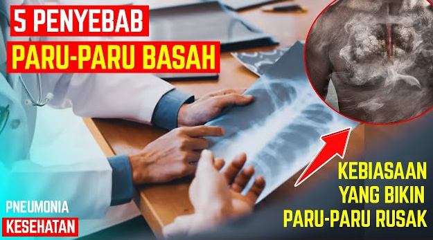 Setiap Tahun, 50 Ribu Kematian Akibat Paru-Paru Basah, Waspada! Berikut 5 Penyebabnya 