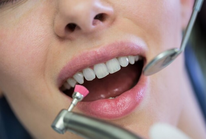 Jangan Dulu ke Dokter! Berikut Cara Ampuh dan Cepat Mengatasi Karang Gigi, Cuma 5 Menit 
