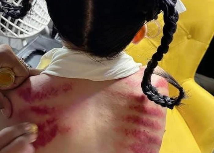 Masuk Angin Jangan Disepelekan, Pakar Kesehatan Ungkap Risiko Penyakit Serius