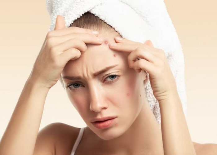 Cara Mengatasi Bekas Jerawat yang Bikin Wajah Kemerahan dengan Skincare
