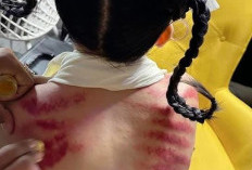 Masuk Angin Jangan Disepelekan, Pakar Kesehatan Ungkap Risiko Penyakit Serius